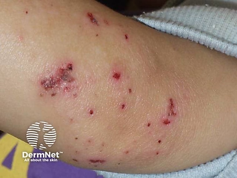 NEA Data Highlight Persistent Access Issues in Eczema - Dermatology
Times